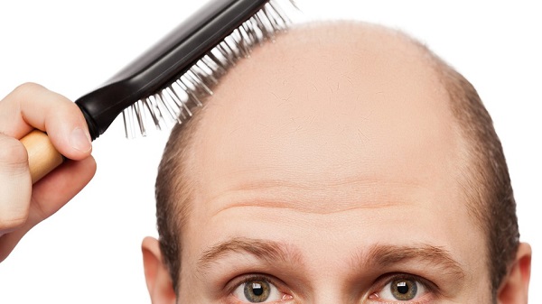 Những người đã bị hói nặng thì không nên sử dụng Rogaine
