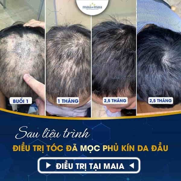 rụng tóc do DHT