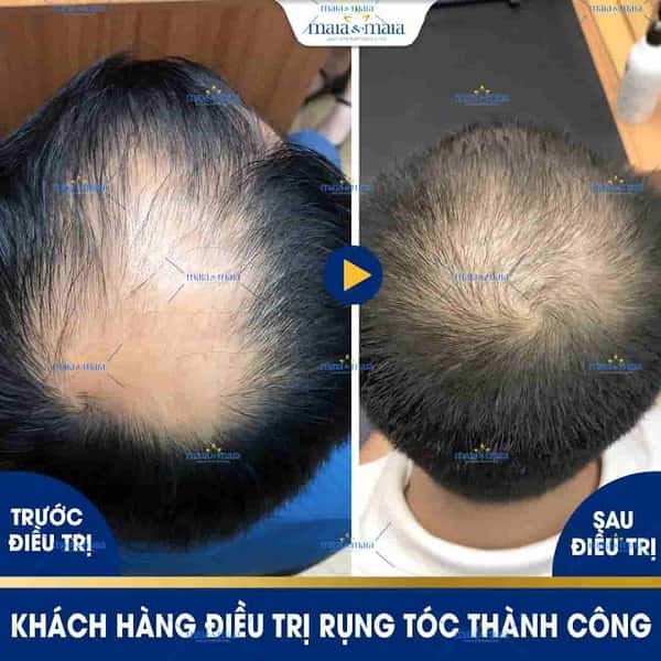 rụng tóc do DHT