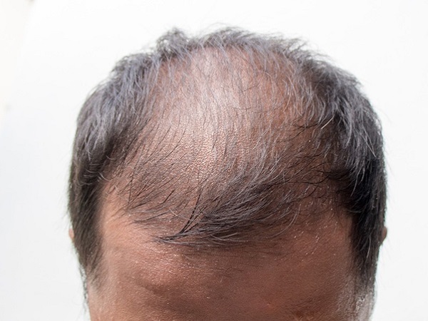 Hói đầu ở nam giới do DHT