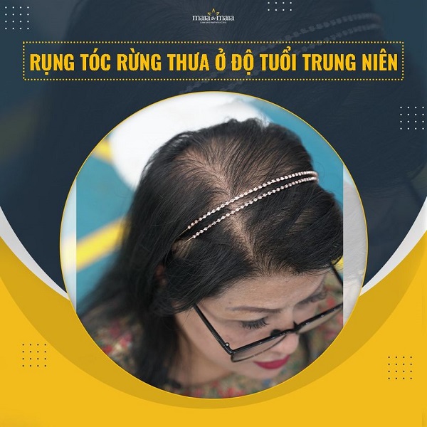 Rụng tóc do nội tiết ở nữ giới