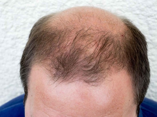 Kiểu rụng tóc hói đầu phổ biến do androgen
