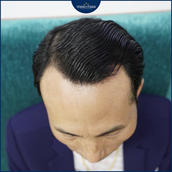 Minoxidil có thể gây một số tác dụng phụ