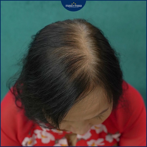 Nữ giới cũng có thể sử dụng Minoxidil điều trị rụng tóc