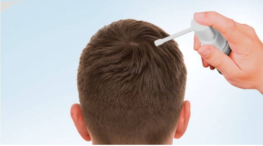 Sử dụng Minoxidil điều trị rụng tóc có thể dẩy nhanh tốc độ phát triển của tóc