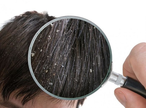 Các vảy gàu là biểu hiện hiện thường đi kèm với ngứa da đầu