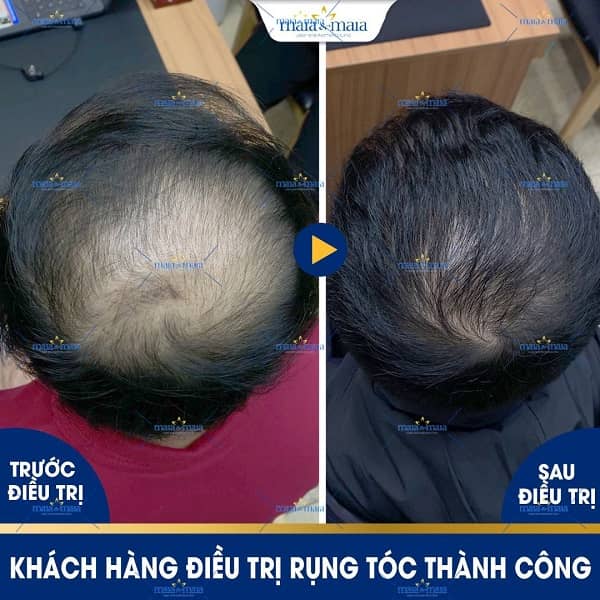 phương pháp điều trị rụng tóc