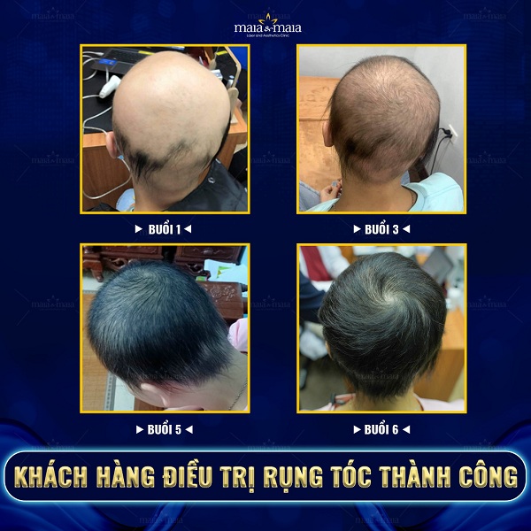 Khách hàng điều trị rụng tóc thành công tại phòng khám Maia