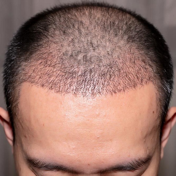 Mái tóc đã được cấy ở cùng trước trán