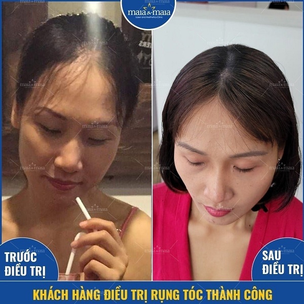Hiệu quả điều trị rụng tóc sau sinh