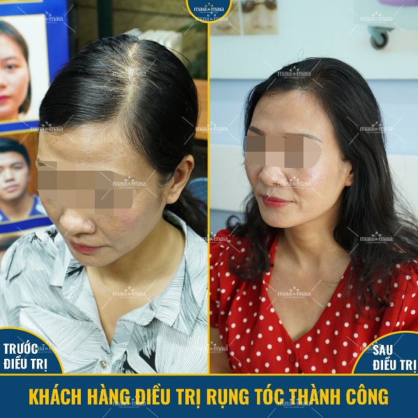 Mái tóc dày dặn trở lại sau khi điều trị tại Maia
