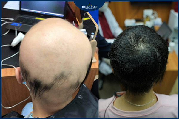 Khắc phục rụng tóc ở nữ giới thành công tại phòng khám Maia