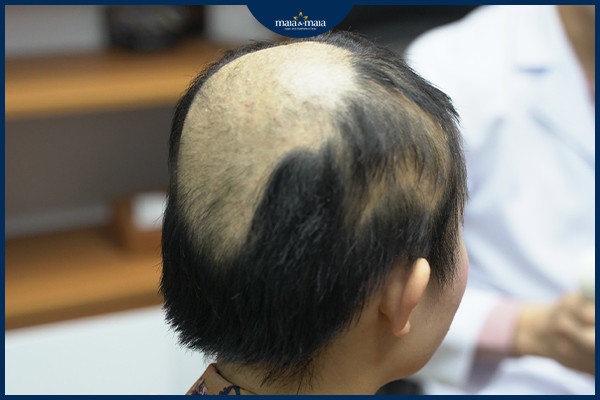 Rụng tóc do bệnh lý trên da đầu