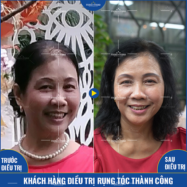 Hiệu quả từ phương pháp đa trị liệu hỗ trợ điều trị rụng tóc của phòng khám Maia