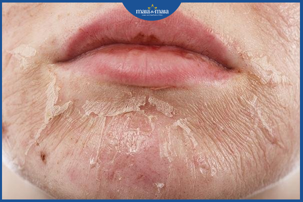Peel da cũng là một phương pháp điều trị nám da phổ biến