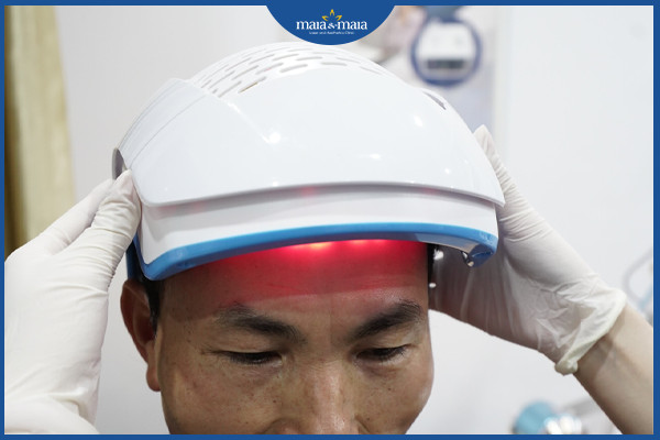 Mũ laser chiếu ánh sáng kích thích mọc tóc
