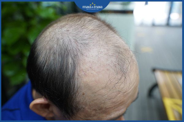 Kiểu rụng tóc nam thường gặp nhất là rụng tóc kiểu hói
