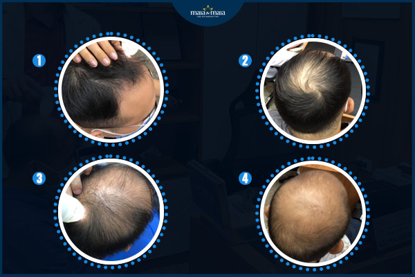 Rụng tóc kiểu hói ở nam giới