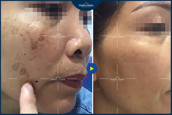 Kết quả điều trị nám da tại phòng khám Maia