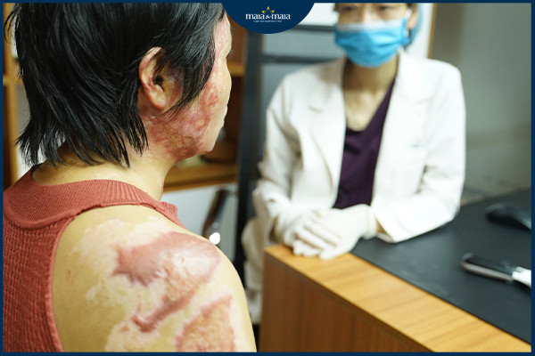 Sẹo lồi diện tích rộng do bỏng da