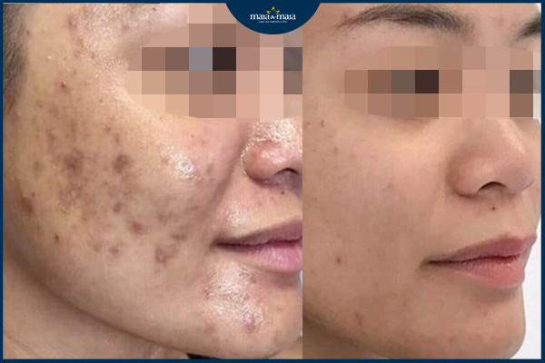 Hiệu quả sau điều trị mụn và sẹo tại phòng khám Maia