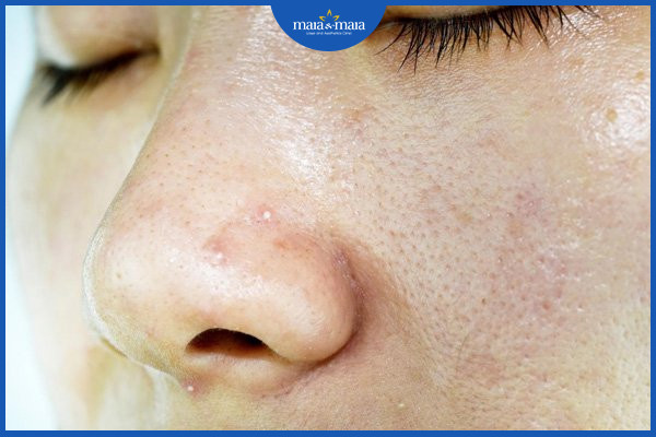 Da dầu cũng cần giữ ẩm để tránh đổ dầu thừa