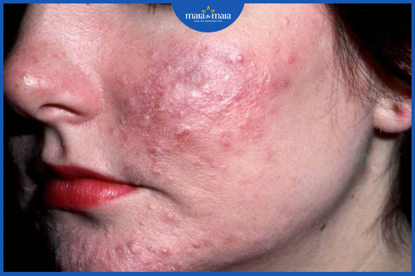 Bệnh thường xuất hiện ở vùng má, mũi và cằm