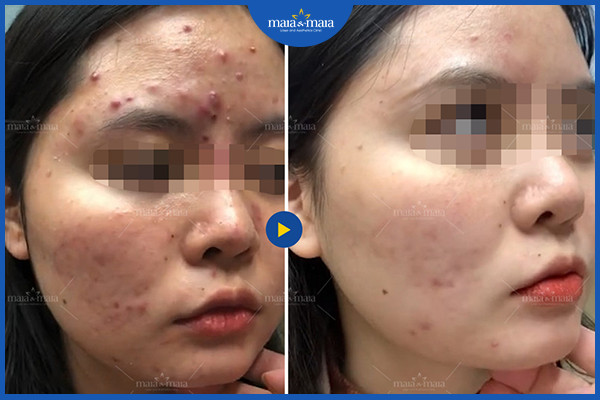 Hiệu quả sau khi điều trị mụn tại phòng khám Maia