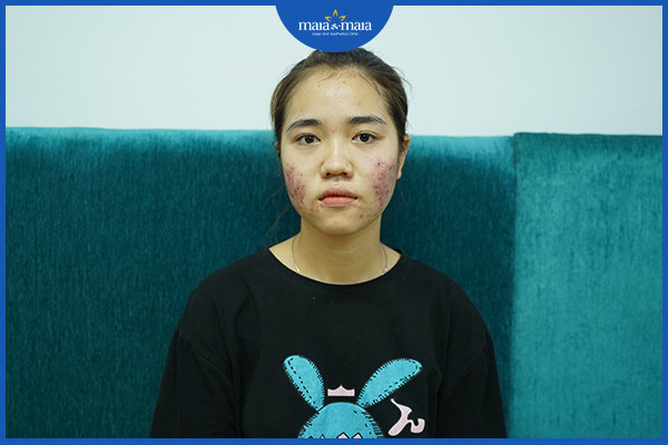 Nội tiết là một trong những nguyên nhân gây ra tình trạng mụn trứng cá