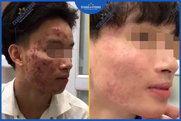 Cần điều trị mụn sớm để tránh hình thành sẹo trên da