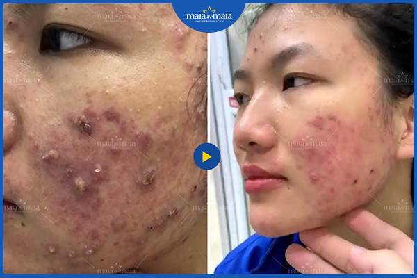 Hiệu quả cải thiện mụn trứng cá sau 3 buổi nhờ điều trị đúng cách