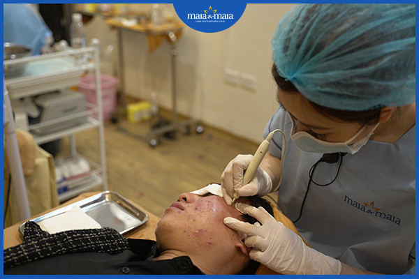 Nặn mụn trứng cá bằng Laser Diot tại phòng khám Maia