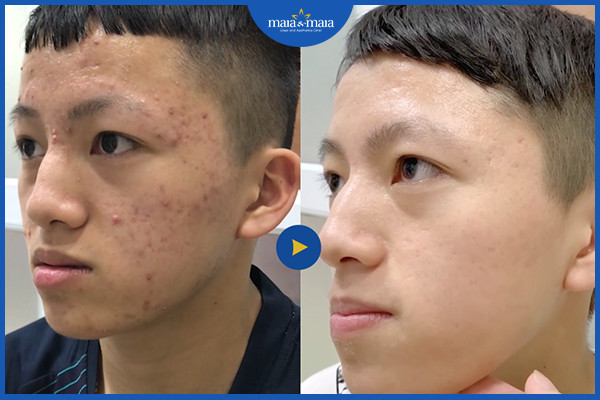 Cần thăm khám với bác sĩ da liễu để được tư vấn điều trị mụn đúng cách