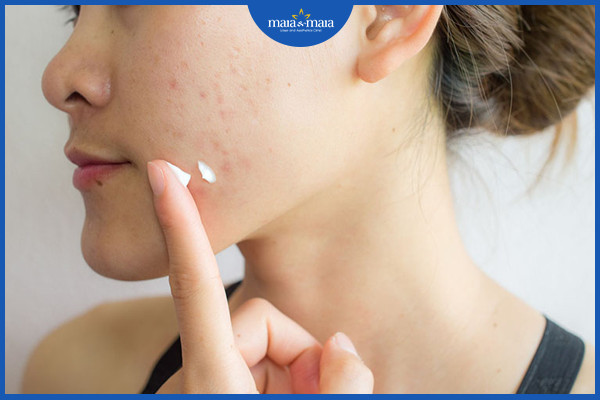 Sử dụng các sản phẩm đường thoa là cách để duy trì hiệu quả điều trị mụn