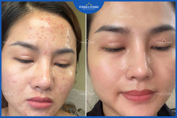 Cần kiểm soát tốt các yếu tố gây mụn để ngăn mụn tái phát