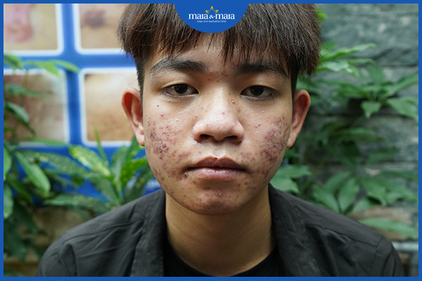 Cần kết hợp điều trị mụn và chăm sóc da để duy trì hiệu quả