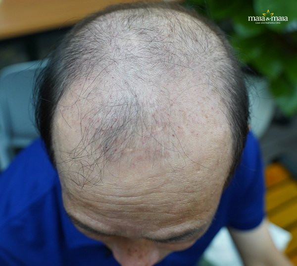 Hói đầu ở nam giới Hói đầu ở nam giới