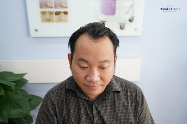 Hói chữ M Hói chữ M