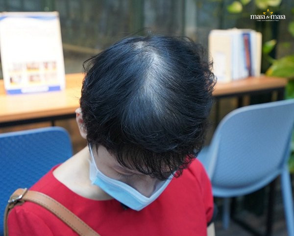 Rụng tóc nội tiết ở nữ giới Rụng tóc nội tiết ở nữ giới