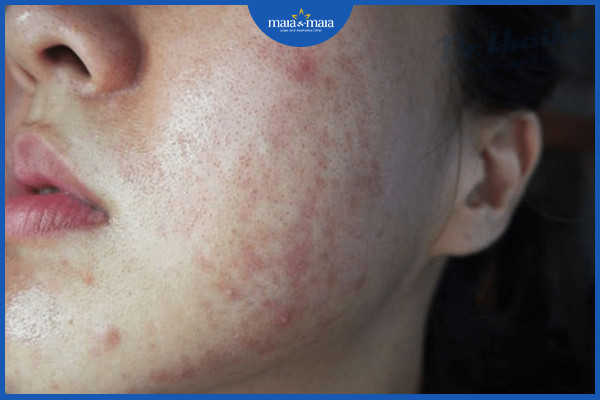 Tăng sắc tố sau khi hết mụn trứng cá