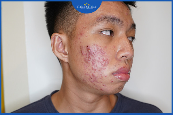 Cạy mụn có thể khiến mụn trở nên nghiêm trọng hơn
