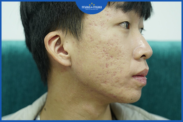 Sẹo rỗ là một trong những hậu quả do trị mụn trứng cá không đúng cách