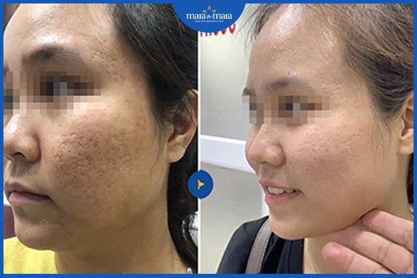 Hiệu quả điều trị sẹo rỗ bằng đa trị liệu tại phòng khám Maia