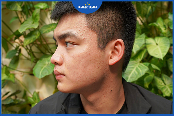 Mụn ẩn là tình loại mụn nằm sâu dưới da