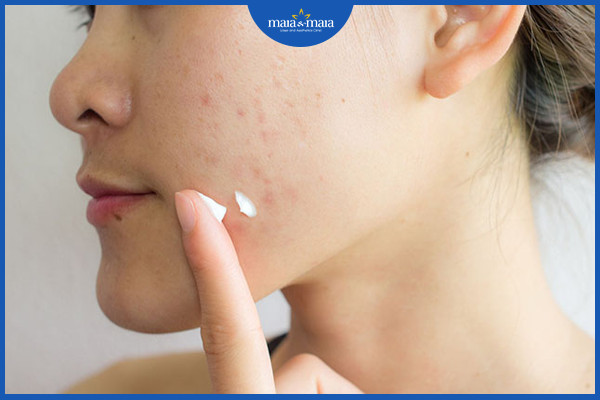 Thuốc bôi là một phương pháp để kiểm soát dầu trên da