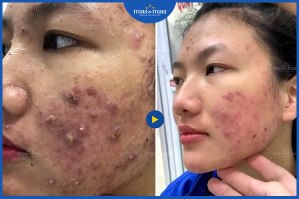 Cần xử lý mụn viêm đúng cách để không để lại di chứng