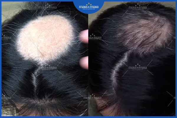 Kết quả điều trị rụng tóc sau 3 buổi tại phòng khám