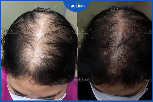 Hiệu quả sau 1/3 liệu trình hỗ trợ điều trị rụng tóc tại phòng khám Maia