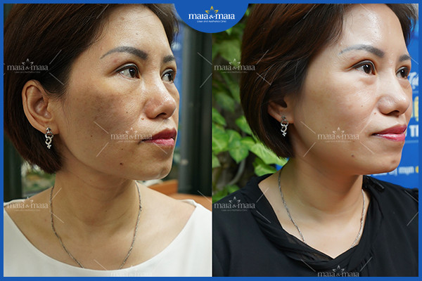 Hiệu quả điều trị nám sau điều trị tại phòng khám Maia