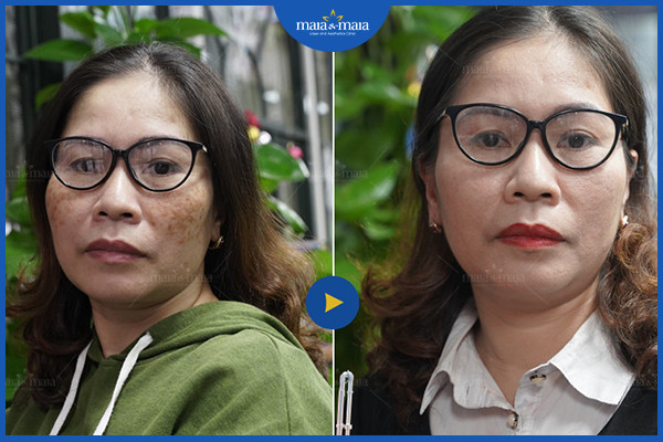 Điều trị nám da độ tuổi tiền mãn kinh